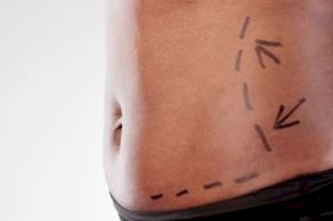 Liposuction Cost in Pakistan: Breaking Down Prices, Factors, and Real Patient Insights