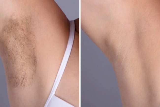 Electrolysis Laser hair removal treatments in Dubai for Sensitive Skin Areas