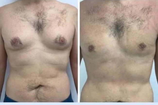 Gynecomastia Surgery in dubai for Health and Aesthetic Goals