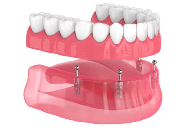 How to Choose the Right Dentures for Your Needs 