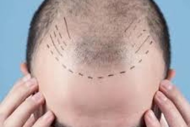 دليلك الشامل حول زراعة الشعر في الرياض: التقنيات، التكلفة، والنتائج المتوقعة