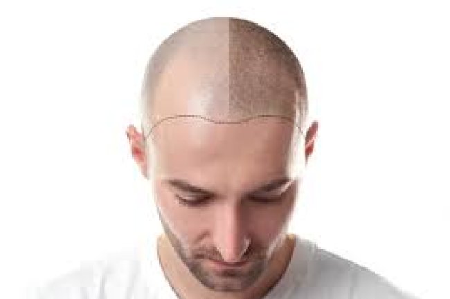 Affordable Hair Transplant in Islamabad’s F-7 and F-10 Areas