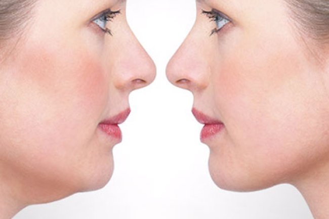 Injectable Treatments for Double Chin Reduction in Islamabad