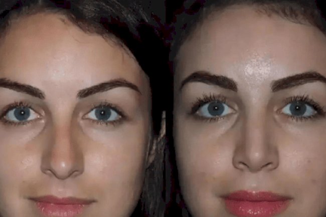 Best Rhinoplasty Surgeon in Dubai for Advanced Rhinoplasty Care