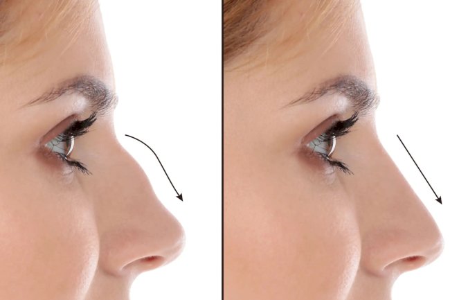 Best Septoplasty Surgeons in Dubai for Evidence-Based Correction