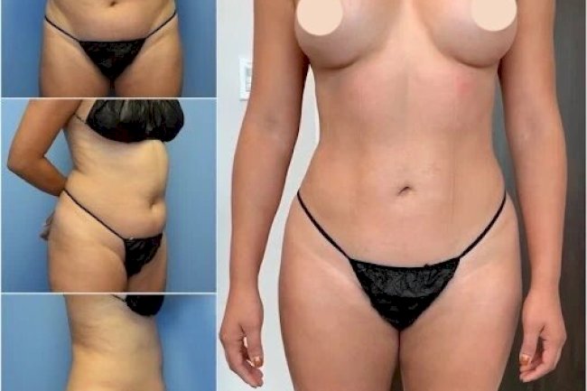 Best Doctors in Dubai for Body Contouring and Body Reshaping Excellence