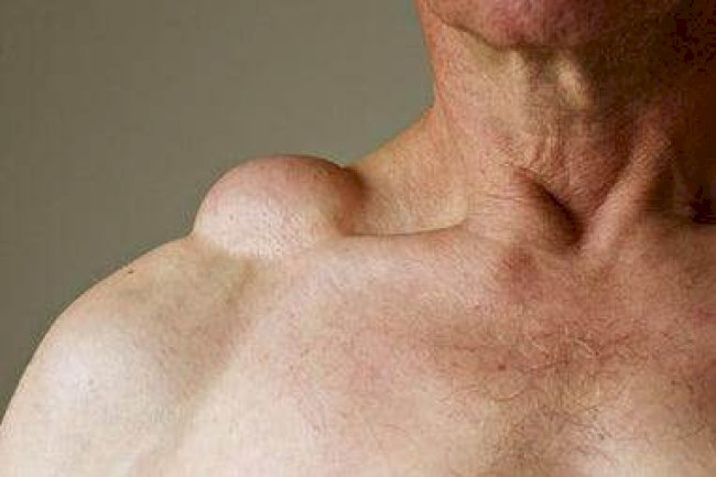 Lipoma Surgery in Islamabad’s Top Hospitals