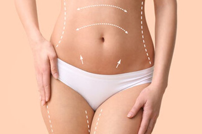 Liposuction for Different Body Types What Works Best?