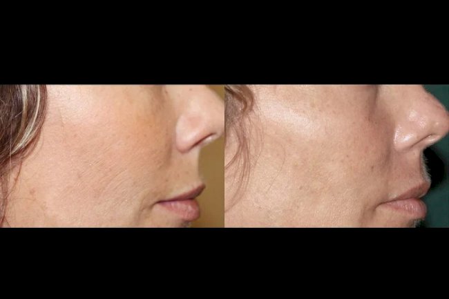 Collagen Renewal with Fractional RF Microneedling by the Best Plastic Surgeons in Dubai