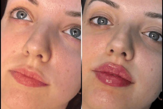 Best Aesthetic Clinics in dubai for Fillers Expert Touch for Flawless Skin