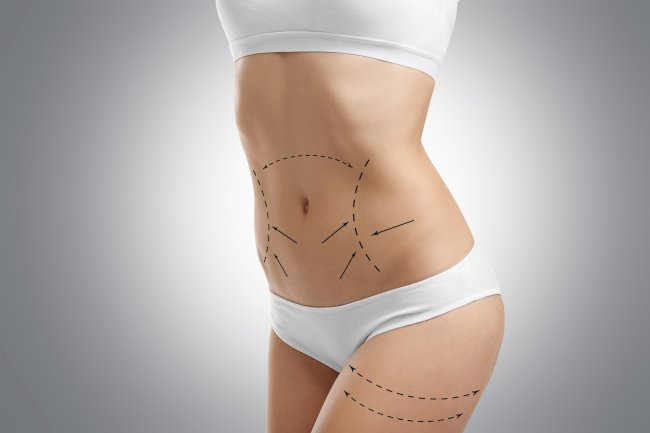 Are You an Ideal Candidate for Transformative Liposuction Results?