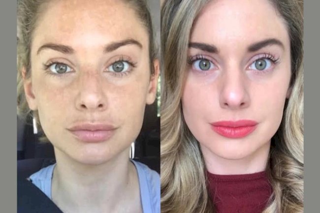 Visible Results with Radiofrequency (RF) Microneedling by the Best Aesthetic Clinic in Dubai
