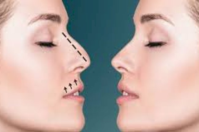 Celebrity-Inspired Rhinoplasty: Natural Looks Without Overdoing It