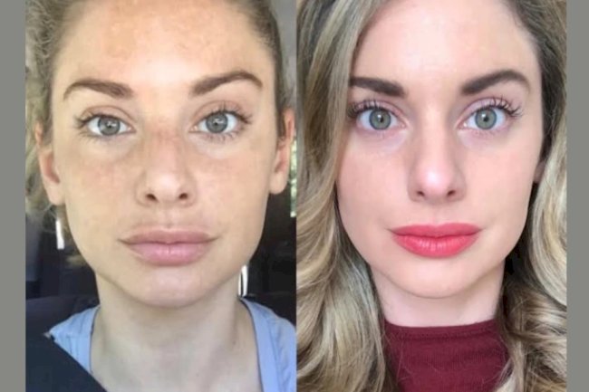 Premium RF Microneedling Treatment in Dubai for Anti-Aging