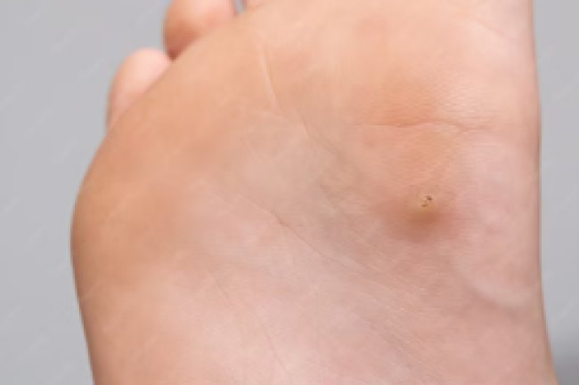 Wart vs Corn: Everything Athletes Need to Know