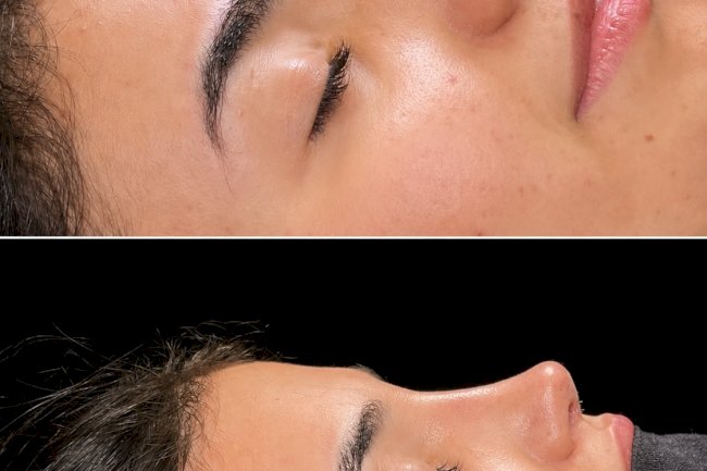 How Rhinoplasty in Islamabad Combines Medical Knowledge With Aesthetic Vision