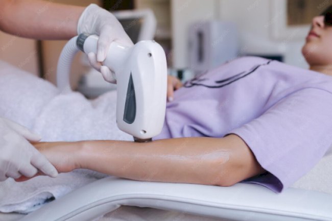 Laser Scar Removal for Acne Scars: Could It Improve Uneven Skin Texture?