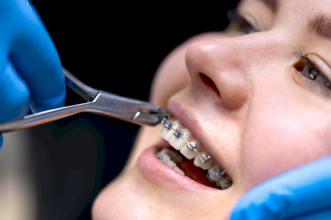Dental Braces in Richmond: What You Need to Know Before Treatment