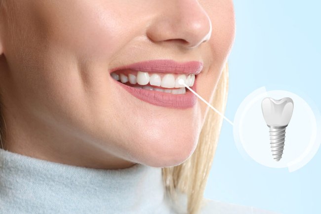 What Makes Someone a Good Candidate for Same-Day Dental Implants?