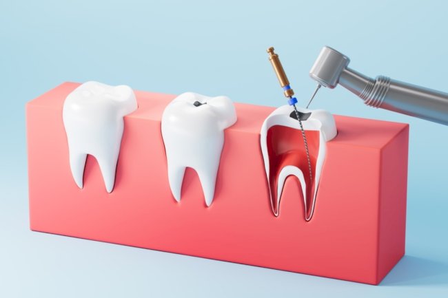 What Happens If You Delay Root Canal Treatment for an Infected Tooth?