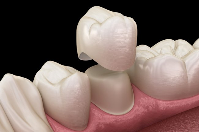 When Is a Cracked Tooth Better Treated With a Dental Crown?