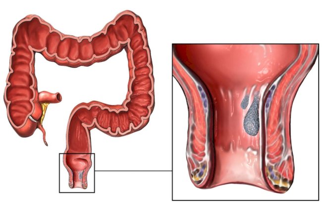 How to Identify the Initial Symptoms of Rectal Prolapse 