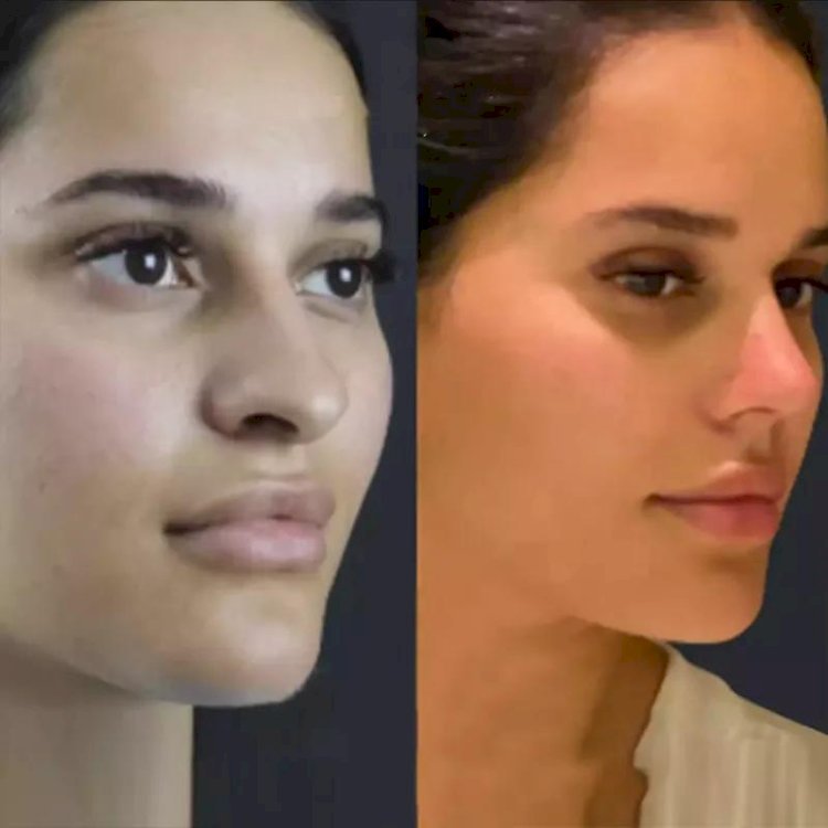 The Cost of Rhinoplasty in Islamabad: A Comprehensive Guide