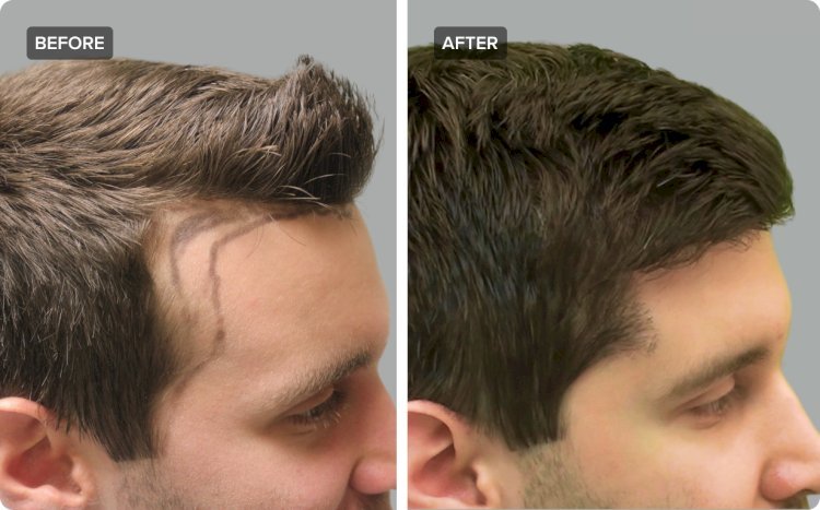 Best Hair Transplant in Pakistan: A Comprehensive Guide