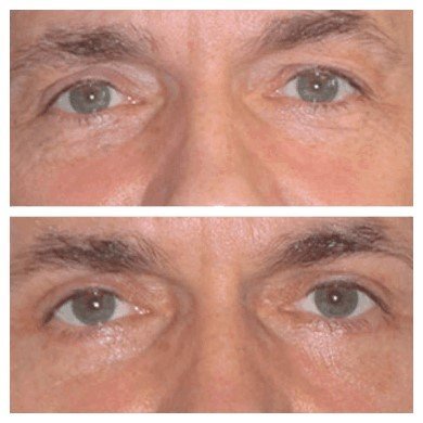 Eye Bag Fat Removal Surgery and Makeup: Enhancing Your Results