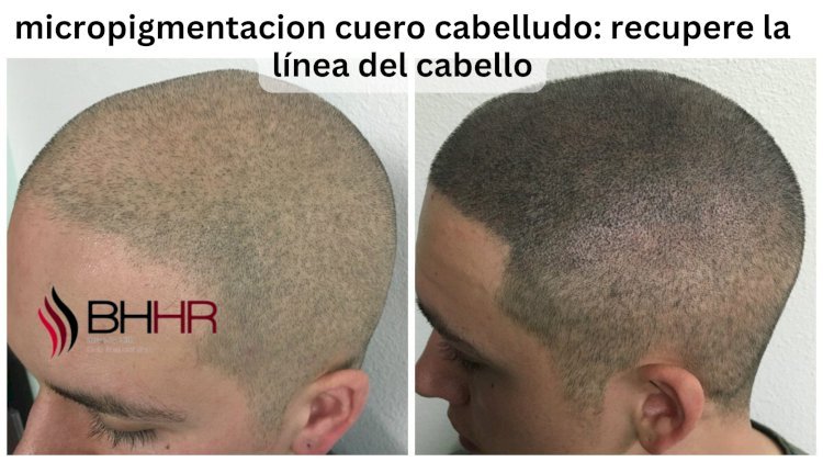 micropigmentacion cuero cabelludo: recupere la línea del cabello