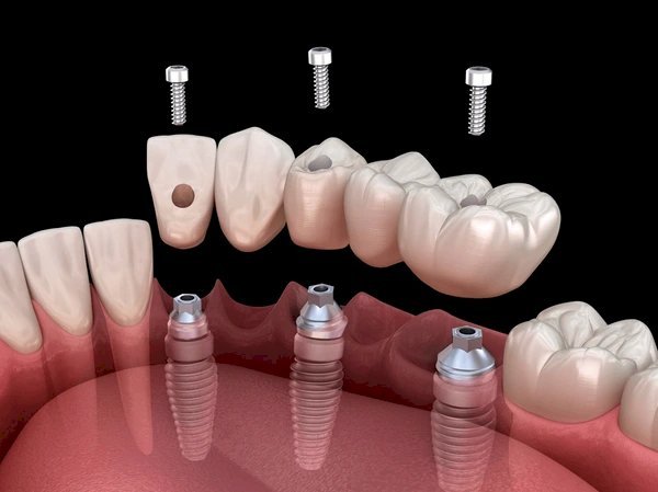 Selecting the Ideal Dental Bridge: Types and Benefits Explored