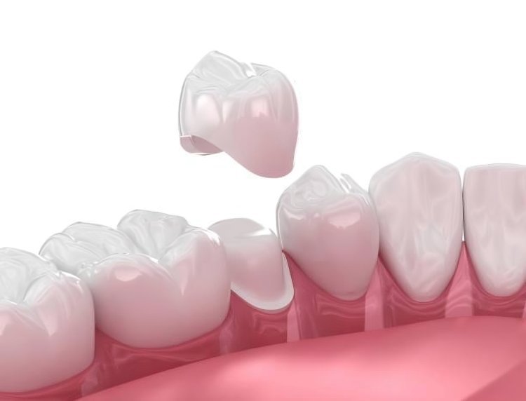 How to Choose the Perfect Dental Crown for Your Needs?