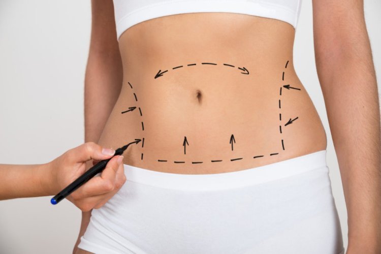 Genetics Role for Results Liposuction in Dubai