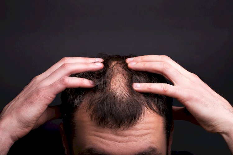 Can hair loss be stopped?