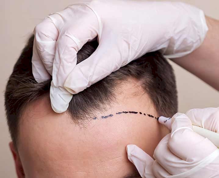 5 Essential Tips to Consider Before Undergoing Hair Transplant Procedure!