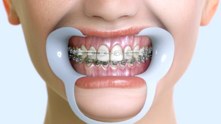 Oral Braces Hygiene During Orthodontic Treatment