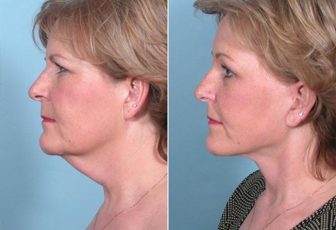 Smas Facelift Before and After: The Ultimate Transformation Experience