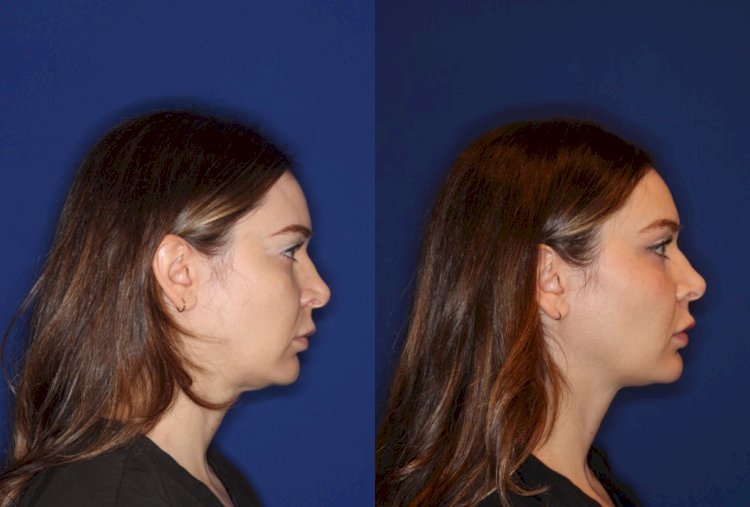 Neck Liposuction NYC: Expert Guide to Achieving Your Ideal Neck Profile