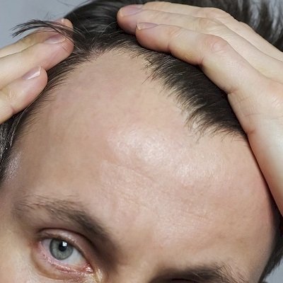 Is Hair Loss Permanent? Understanding Causes and Solutions