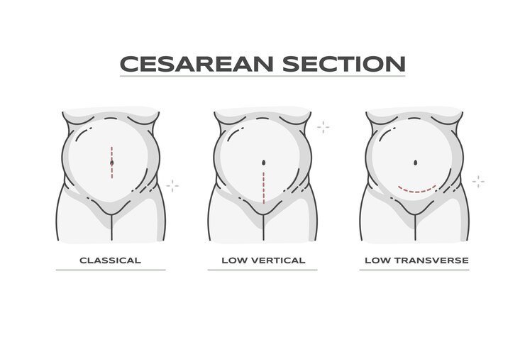 Exploring the Pros and Cons of C-Section and Normal Birth