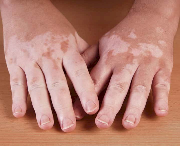 Vitiligo Contagiousness: Balancing the Myths from the Facts