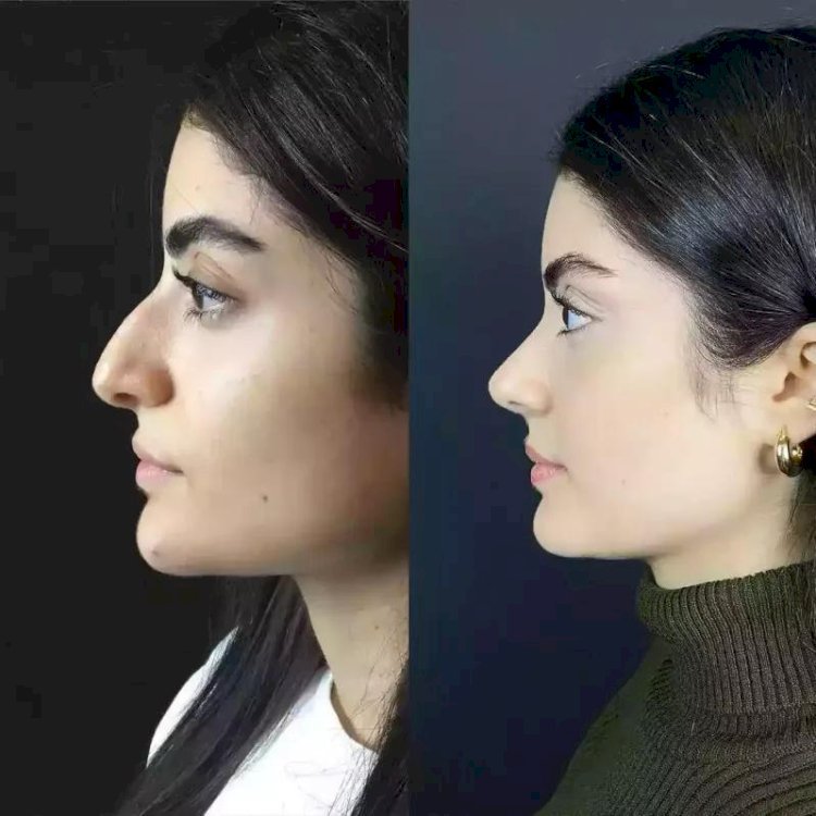 Best Clinics for Rhinoplasty Surgery in Dubai