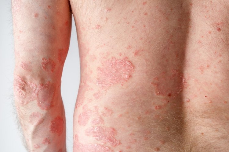 What are the Warning Signs of Psoriasis?