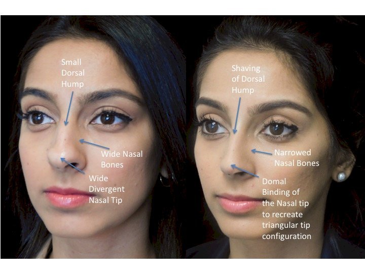 Nose Job for Bulbous Tip: A Complete Guide to Refining Your Look