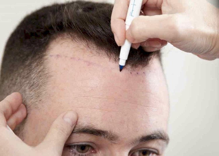 Hair Loss Medication vs. Hair Transplant: What’s Best?