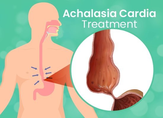 New Treatment for Achalasia You Can’t Miss: The Latest Achalasia Solution