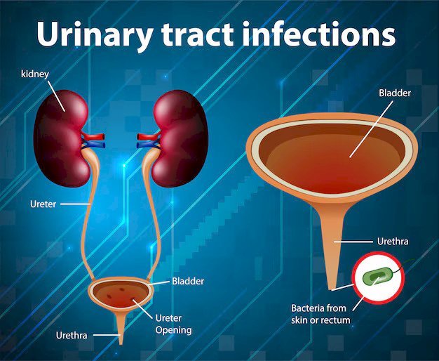 Effective Urinary Tract Infection Treatments: A Comprehensive Guide