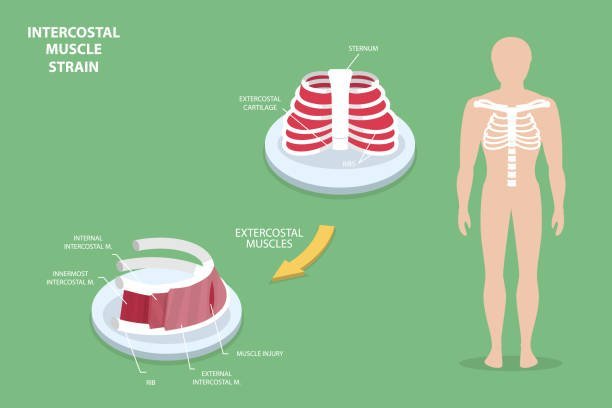 How to Sleep With Intercostal Muscle Strain