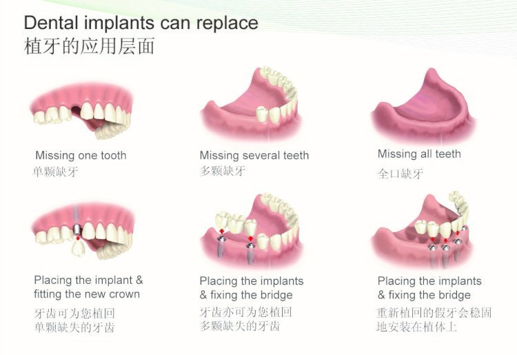 Exploring Denture Implants: A Reliable Solution for Restoring Your Smile