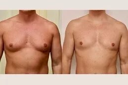 Best Doctors in Dubai: Redefining Male Chest Contouring